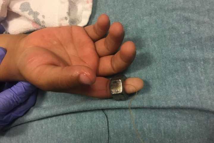 Firefighters Remove Steel Nut From Child’s Finger