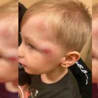 <p>Tiffany and John Hawk's 4-year-old son's injuries following the serious hit-and-run on Halloween.</p>