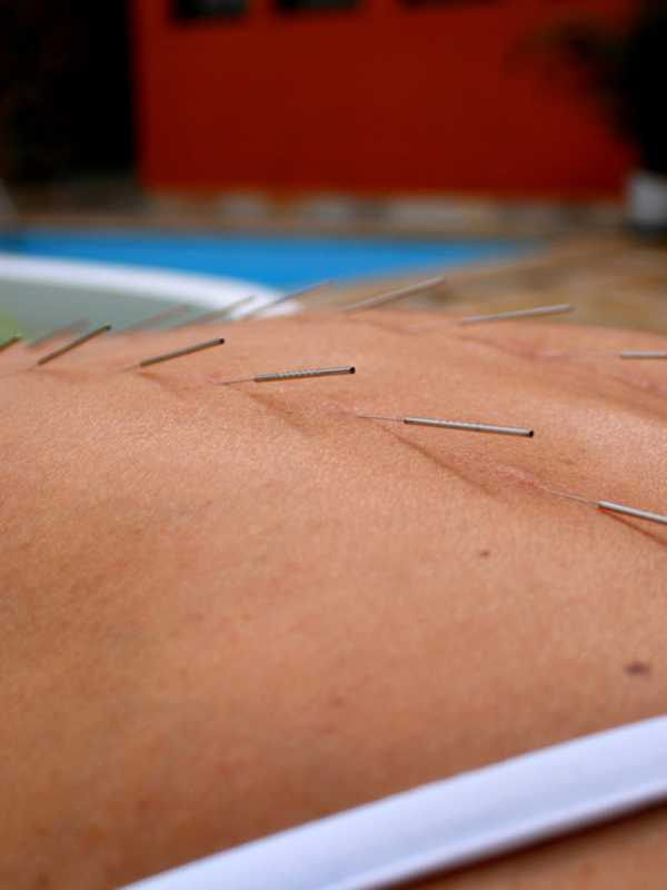 East Fishkill Library Holds Acupuncture Talk For Pain