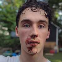 <p>Aydin Pedone, age 15, suffered a broken nose when he was allegedly assaulted by a 14-year-old girl at Derby Park in Hudson Falls on Wednesday, June 21.</p>