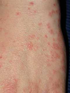 Student At Liberty Elementary School Diagnosed With Scabies