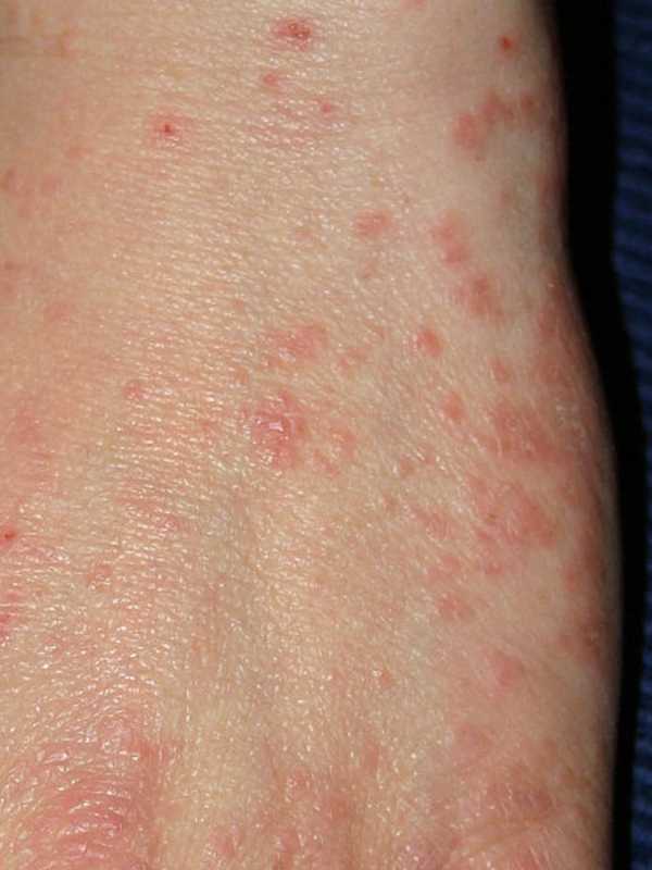 Student At Liberty Elementary School Diagnosed With Scabies
