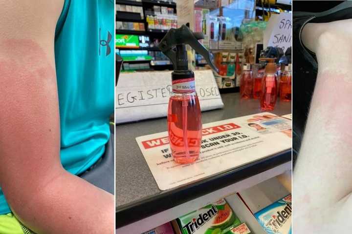 Store Owner Charged With Endangerment For Selling Homemade Sanitizer That Burned Bergen Boys