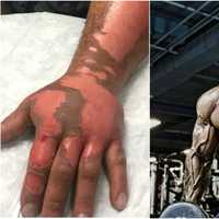 Westchester Bodybuilder Burned By Exploding Cooking Spray; Support Surges
