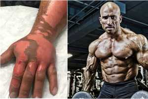 Westchester Bodybuilder Burned By Exploding Cooking Spray; Support Surges
