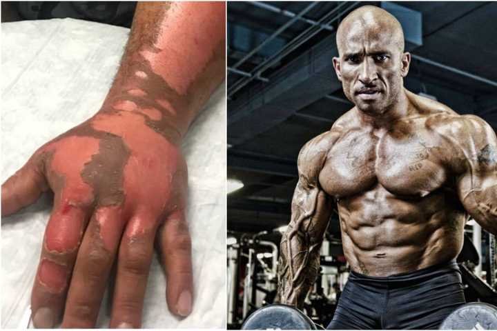 Westchester Bodybuilder Burned By Exploding Cooking Spray; Support Surges