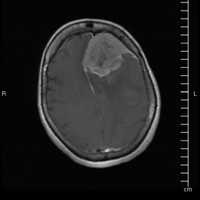 <p>Before surgery at BSSNY, a scan shows a large brain tumor.</p>