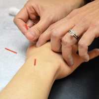 <p>Needling for tendinitis.</p>