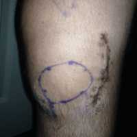 <p>Dylan&#x27;s knee surgery post-op with a four inch incision closed with dissolving stitches.</p>