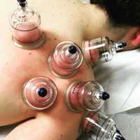 <p>DeCicco uses cupping to treat shoulder pain.</p>