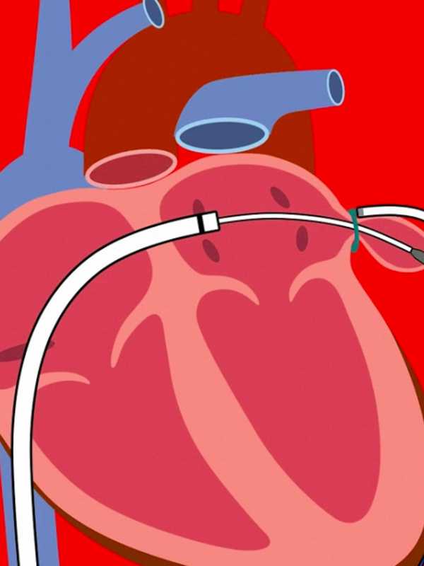 Valley Hospital Keep The Beat Going With Innovative Heart Care
