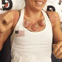 <p>Twelve-time olympic medalist Natalie Coughlin gets cupping treatment.</p>