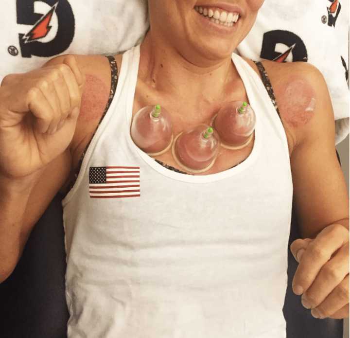 Twelve-time olympic medalist Natalie Coughlin gets cupping treatment.