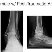 <p>An x-ray of Debbie Mullady&#x27;s ankle before the surgery.</p>