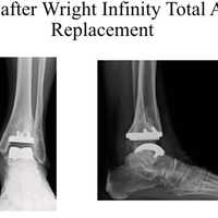 <p>An x-ray of Debbie Mullady&#x27;s ankle after replacement surgery by Dr. Randolph Sealey of Danbury Orthopedics.</p>