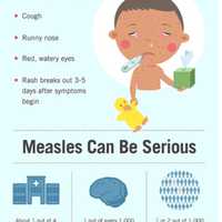 <p>A look at measles symptoms.</p>