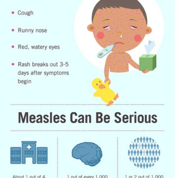 A look at measles symptoms.