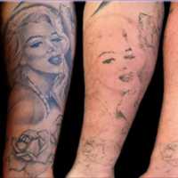 <p>Tattoo removal by Clean Slate Laser in Wayne.</p>