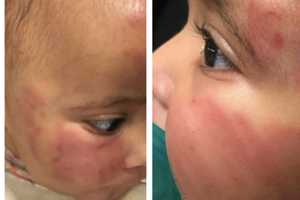 Baby Badly Bruised At Unlicensed Newark Daycare, Mom Says