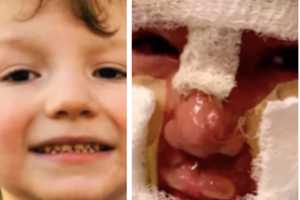 Bully Throwing Fireball Leaves CT Boy Severely Burned, Family Says