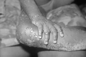 Monkeypox Arrives In Philadelphia: Reports