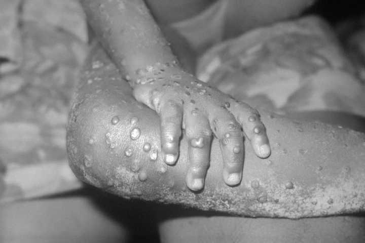 Monkeypox Arrives In Philadelphia: Reports