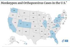 CDC Raises Monkeypox Alert Level As Number Of US Cases Rises