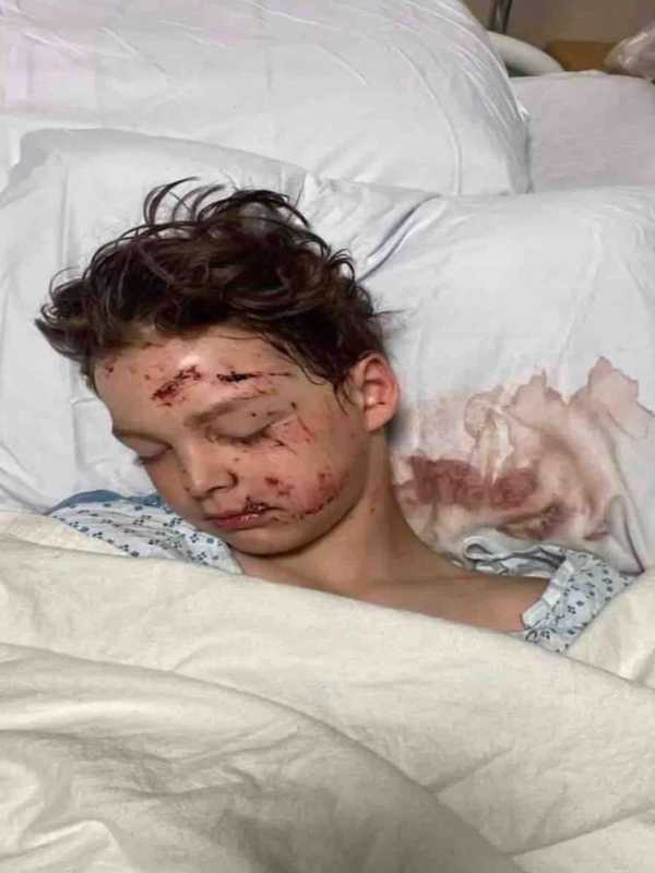 Young Bicyclist Embedded In Windshield In Jersey Shore DUI Crash Faces Long Road To Recovery