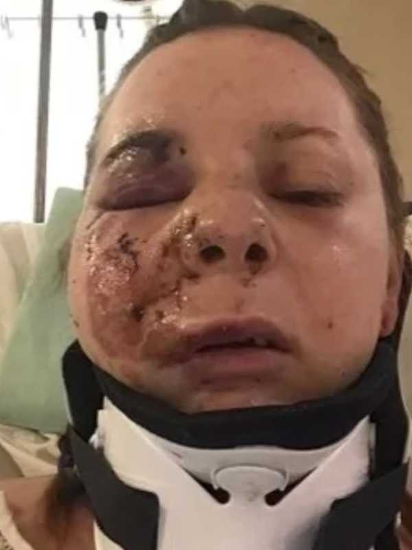 Countless Facial Fractures Among Injuries Suffered By NJ Woman Dragged, Struck By Cars