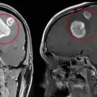 <p>Kyle Graham's tumor.</p>