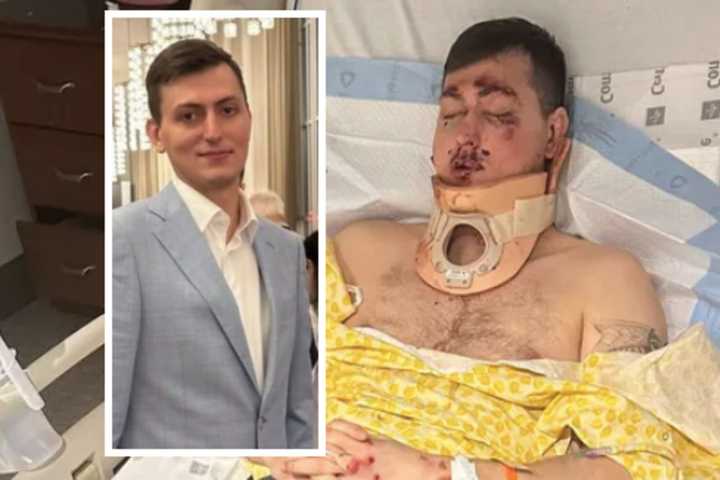 DC Bartender Broke Nearly Every Bone In His Face In Crash He Can't Remember, Brother Says