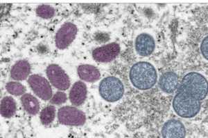 New Case Of Monkeypox Reported In Hudson Valley
