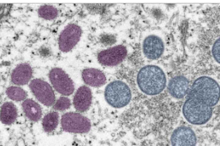 New Case Of Monkeypox Reported In Hudson Valley