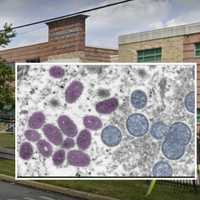 West Chester University Student Tests Positive For Monkeypox
