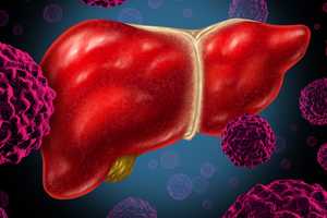 A Worrisome Trend: More Cases Of Liver Cancer