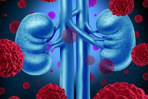 Preventable Yet Undetectable: Learn The Facts About Kidney Cancer
