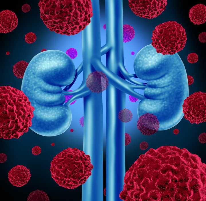 NewYork-Presbyterian is at the forefront of innovative kidney cancer prevention and treatment.