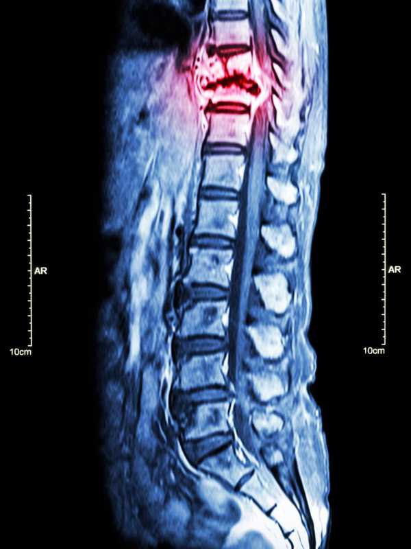 What Happens When Cancer Strikes The Bones? NYP Explains Deadly Diagnosis