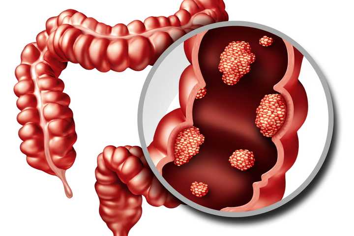 Colorectal Cancer: A Preventable Cancer Affecting Young Patients