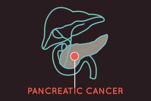 Pancreatic Cancer: Trying To Outwit A Killer