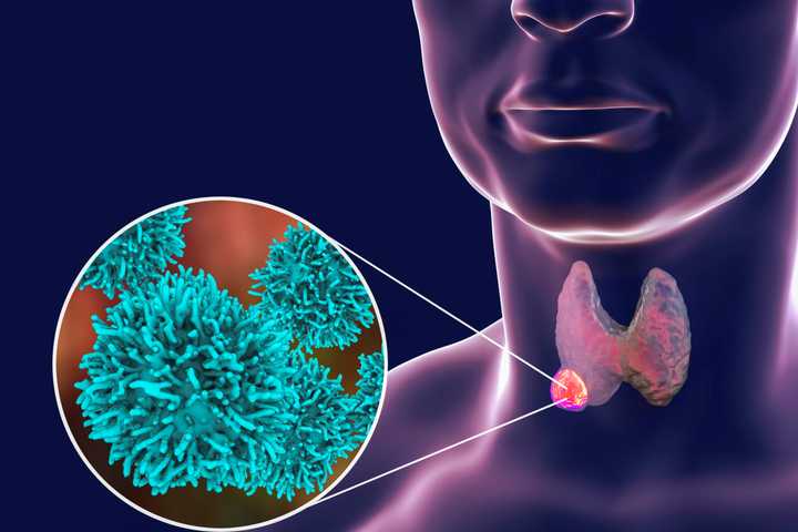 Thyroid Cancer: A Rising Trend But Minimal Threat