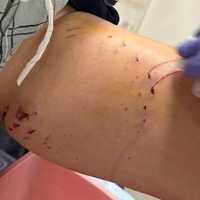 <p>Lyudmila Emag&#x27;s wounds after being bitten in the thigh by a shark near Fire Island on Tuesday, July 4.</p>