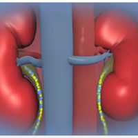 Study May Bring New Hope For Those Needing Kidney Transplant