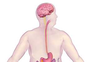 Hackensack Hospital First In State To Implant Anti-Obesity Device