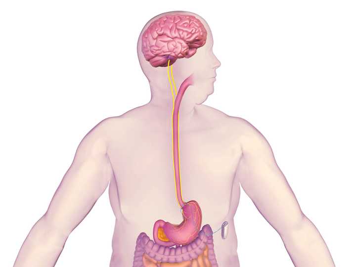 Hackensack University Medical Center has become the first hospital in New Jersey to implant vBloc Therapy for the treatment of obesity, according to an announcement. This illustration shows how vBloc Therapy works.