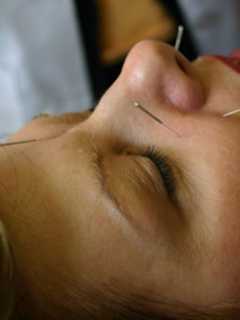 Wilton Acupuncturist Touts Its Preventative Health Benefits