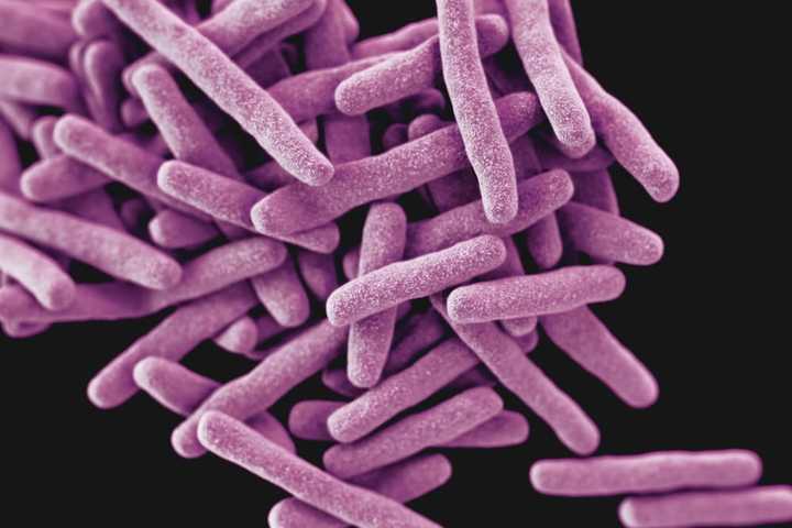 Active Tuberculosis Case Leaves 40 People Exposed At UMass Boston: Officials