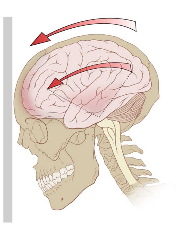 Experts Talk Concussions At Rockland Community College Seminar