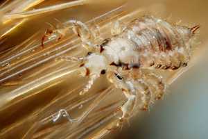 'Super Lice' Spread To 28 States, Including New York