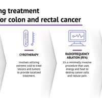 <p>There are different approaches for treating colon and rectal cancer.</p>